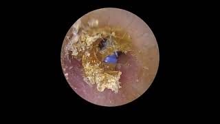 Earwax and Grommet Removal [upl. by Llert]