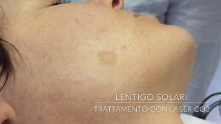 Lentigo solari  Trattamento con Laser CO2 [upl. by Wait]