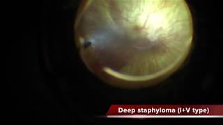 Myopic Foveoschisis with deep staphyloma [upl. by Kiel87]