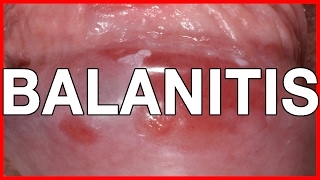 Balanitis Symptoms Causes Treatment and Prevention [upl. by Sally64]