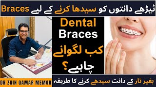 Dental Braces Everything You Should Know About  Types of Dental Braces  All About Braces [upl. by Shep689]