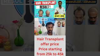 0 to 100 days Hair transplant result hairtransplant shorts trending haircare chennaihairplant [upl. by Amery]