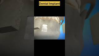 Dental ImplantAnimation Dental Implantsdentalimplantimplantdentist [upl. by Epoh]