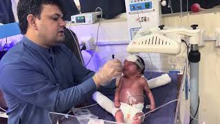 Insertion of Nasogastric Tube in Newborn [upl. by Cence]