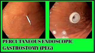 Percutaneous Endoscopic Gastrostomy PEG Tube Deployment  SQUARE HOSPITALS LTD Dhaka BDENDOSCOPY [upl. by Ecar119]