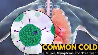 Common Cold Causes Signs and Symptoms Diagnosis and Treatment [upl. by Norrv]