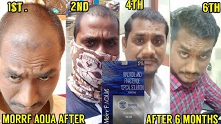 Morr F Minoxidil with Redensyl amp Procapil review after 6 months of use finasteride minoxidil dht [upl. by Arykahs]