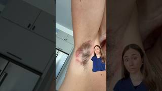 Deodorant Rash Gone Wrong  Must See [upl. by Dorman811]