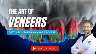 Making Porcelain Veneers  The Art of Veneers [upl. by Bui]