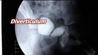 Hutchs diverticulum [upl. by Fabian255]