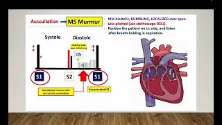 Mitral stenosis  Omar Layth  Cardiology made easy [upl. by Aleahcim]