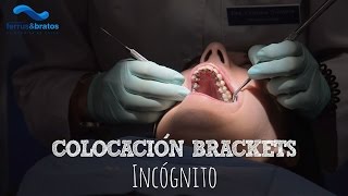 Colocación de brackets linguales Incognito [upl. by Ephraim]