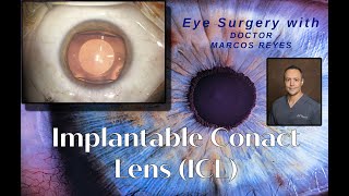 Visian ICL Implantable ContactCollamer Lens [upl. by Pineda]