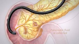 Pancreatic Cancer Screening [upl. by Haeluj]