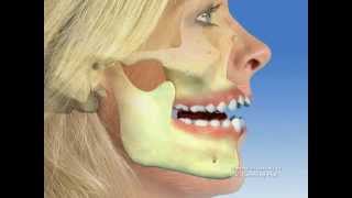 TMJ  Temporomandibular joint dysfunction [upl. by Ama]