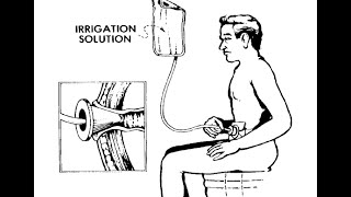 How to Irrigate Your Colostomy [upl. by Dnomzed452]