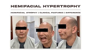 Hemifacial Hypertrophy Vs Hemifacial Atrophy  clinical Features  Etiology [upl. by Ahsinnor]