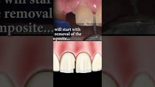 Replacing Crowns on Teeth 710 With BruxZir® Anterior [upl. by Lleret]