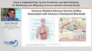 Case Review Monitoring and Managing irAEs [upl. by Leyameg927]