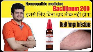 Best Homeopathic Medicine for Fungal Infection Ringworm or tinea corporis  Bacillinum 200 [upl. by Jallier]