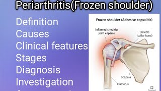 PeriarthritisFrozen shoulderEasy Notes PT Arthopedic condition  Assessment amp PT Management [upl. by Eberhart]