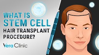 What Is Stem Cell hairtransplant Procedure stemcelltransplant [upl. by Ysus]