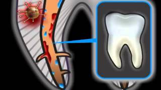 Root Canal Complications in Dentistry [upl. by Drandell]