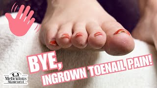 Ingrown Toenail Prevention at Home [upl. by Nohtan]