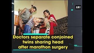 Doctors separate conjoined twins sharing head after marathon surgery  ANI News [upl. by Tizes]