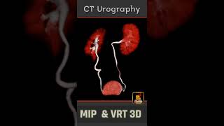 CT Urography  MIP amp VRT 3D  Rad Shorts [upl. by Nitreb]