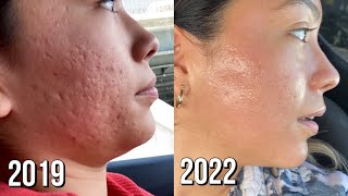 Microneedling Session 8 Before  After [upl. by Vanna874]