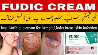 fudic cream uses  fusidic acid cream  antibacterial cream  best cream for acne  infected wound [upl. by Engracia297]