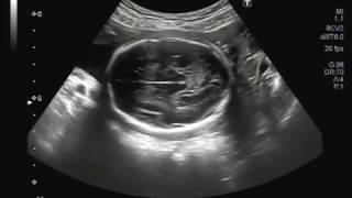 Ultrasound video showing dilated lateral as well as 3rd ventricles of the fetus [upl. by Swope102]