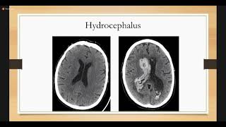 Intracerebral Hemorrhage  Neurology [upl. by Forster953]