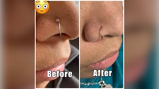 Get rid of that nose piercing bump FOR GOOD Find out what really works Easiest method [upl. by Carol]