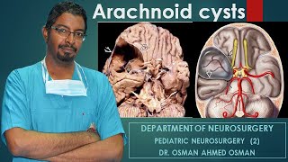 1 Arachnoid cysts Second Part [upl. by Atinrehs]