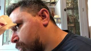 Part 3 Draining Preauricular sinus home cleaning [upl. by Capone370]