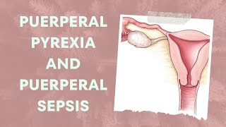 Understanding Puerperal Pyrexia and Puerperal Sepsis Causes Symptoms and Treatment [upl. by Radmilla]