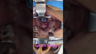 Speech Surgery to correct nasality in voice and depth by dr richardson [upl. by Selwyn281]