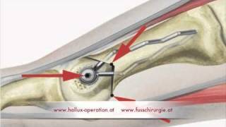 Hallux Operation nach Stoffella Teil 23 Osteotomie [upl. by Warden]