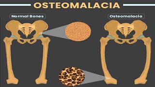 OSTEOMALACIA [upl. by Ardnuasak]