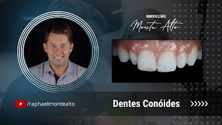 Dentes Conóides [upl. by Eentihw]