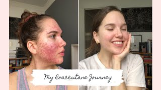 Roaccutane  My 6 Month Journey to Clear Skin [upl. by Frum730]