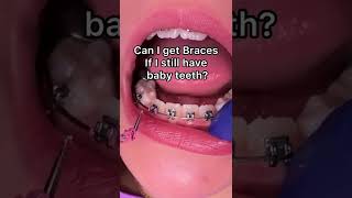 Can you get braces with baby teeth in Tooth Time Family Dentistry New Braunfels Texas [upl. by Emlynn]