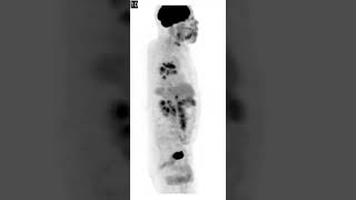 Sarcoidosis Symmetric bilateral hilar hypermetabolic lymphadenopathy [upl. by Alvy518]