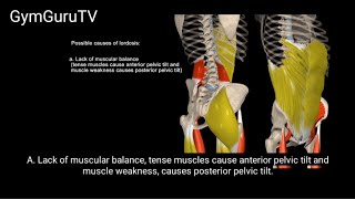 Possible causes of lordosis A lordotic position may be caused by a number of factors [upl. by Icak]