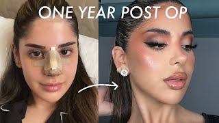 1 YEAR POST OP NOSE JOB UPDATE  QampA [upl. by Mindi]