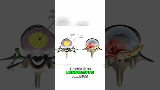 Qu est ce qu une hernie discale Decouvrez les causes et les symptomes [upl. by Nnylamme489]