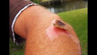 10 Natural Home Remedies to Heal Scabs Fast [upl. by Skoorb]