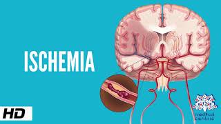 Ischemia Causes Signs and Symptoms Diagnosis and Treatment [upl. by Norse]